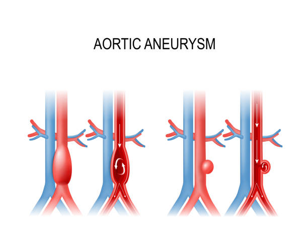 best doctor for aortic aneurysm treatment in navi mumbai